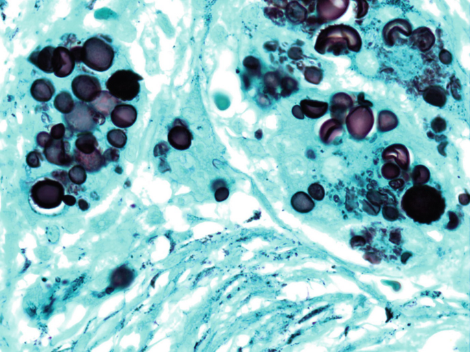 Fungal Stains